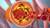 Mεταβολικό σύνδρομο:Τα σημάδια κι ο κίνδυνος καρδιαγγειακού νοσήματος